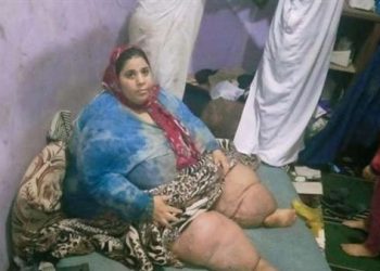 قرار عاجل من التربية التعليم لأبناء مريضة داء الفيل 