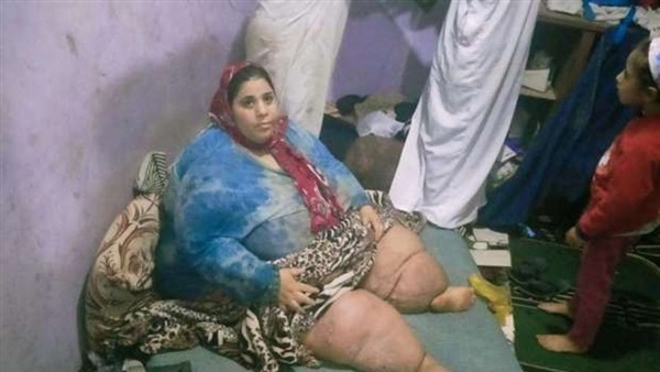 قرار عاجل من التربية التعليم لأبناء مريضة داء الفيل