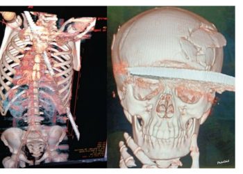 عمليات خطيرة ونادرة قام بها اطباء جامعتى طنطا وسوهاج