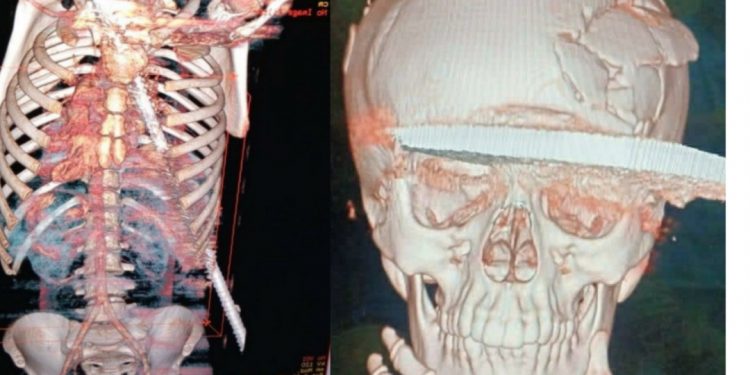 عمليات خطيرة ونادرة قام بها اطباء جامعتى طنطا وسوهاج