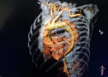 جامعة المنصورة تعلن إجراء أول حالة تيفار بمركز جراحة الأوعية الدموية