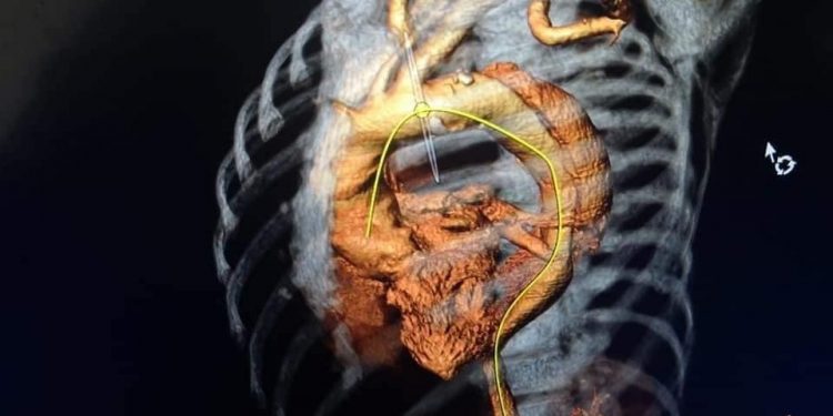 جامعة المنصورة تعلن إجراء أول حالة تيفار بمركز جراحة الأوعية الدموية