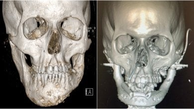 إيطاليا.. أول عملية استبدال للفك السفلي في العالم