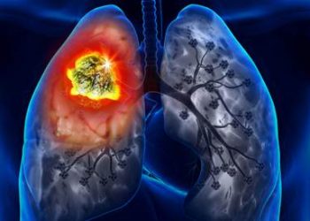 علاج سرطان الرئة بالخارج