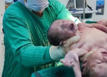 مستشفى جامعة المنصورة تنجح في ولادة توأم ملتصق