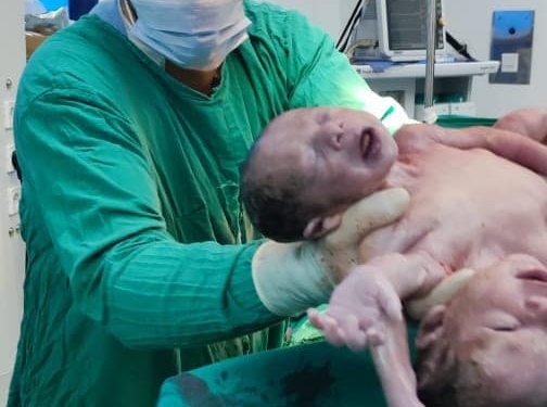 مستشفى جامعة المنصورة تنجح في ولادة توأم ملتصق