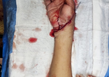 فريق طبي ينجح في إعادة توصيل يد مبتورة في 12 ساعة