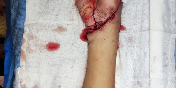 فريق طبي ينجح في إعادة توصيل يد مبتورة في 12 ساعة