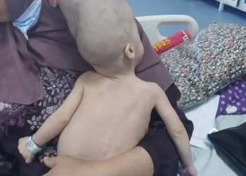 جراحة فصل التوائم الملتصقة نجاحات حققها الأطباء المصريون من بنها للاسكندرية