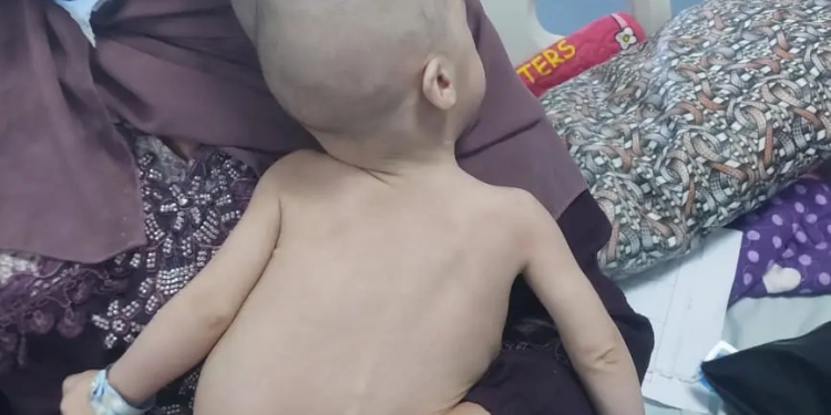 جراحة فصل التوائم الملتصقة نجاحات حققها الأطباء المصريون من بنها للاسكندرية