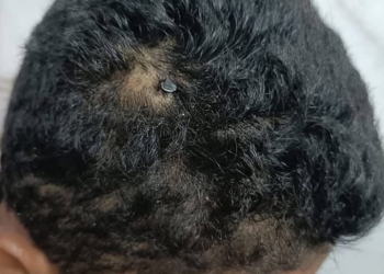 معجزة طبية في الفيوم: استخراج مسمار معدني من جمجمة طفل بعد جراحة استمرت 5 ساعات