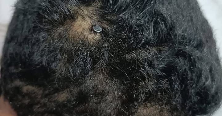 معجزة طبية في الفيوم: استخراج مسمار معدني من جمجمة طفل بعد جراحة استمرت 5 ساعات