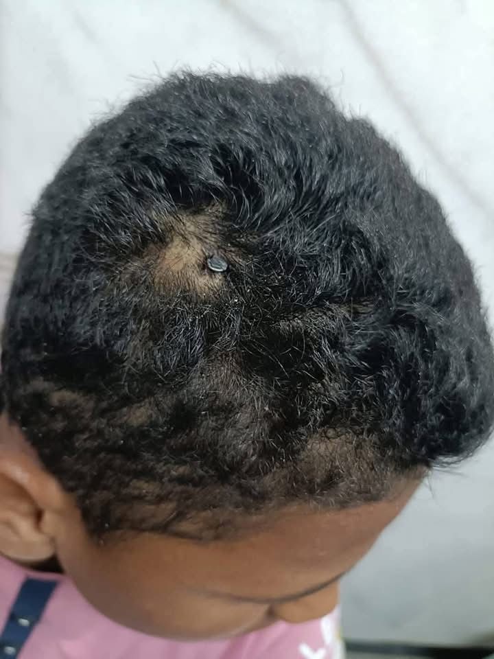 معجزة طبية في الفيوم: استخراج مسمار معدني من جمجمة طفل بعد جراحة استمرت 5 ساعات