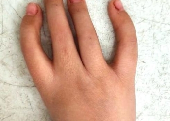 إبهام جديد لطفلة بطب الأزهر.. جراحة نادرة تُعيد لطفلة يدها المفقودة