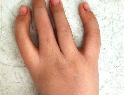 إبهام جديد لطفلة بطب الأزهر.. جراحة نادرة تُعيد لطفلة يدها المفقودة