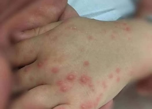 بعد إصابة طلاب بالجيزة بفيروس اليد والقدم والفم (HFMD).. تعرف على الأعراض وطرق الوقاية